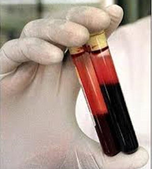 10 Hepatitis B cases recorded weekly in Juba