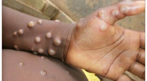 EAC Partner States urged to educate citizens on monkeypox