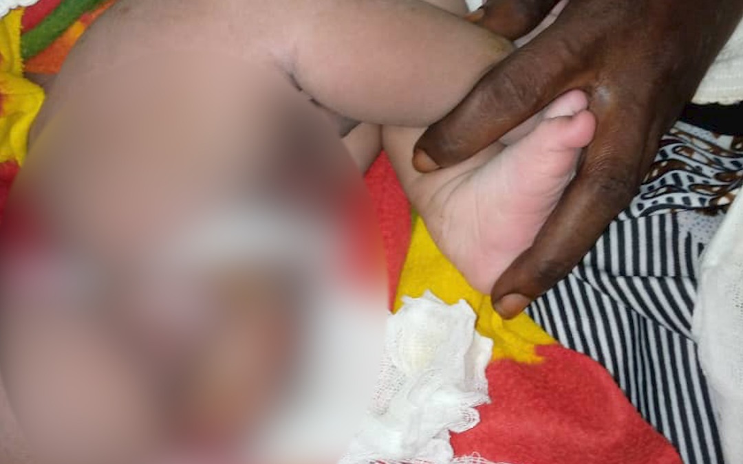 Parents of baby co-joined with deformed twin sibling, need help
