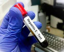 MoH declares Hepatitis E outbreak in Wau