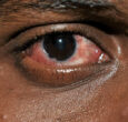 Health Ministry issues high alert over outbreak of Red Eye disease