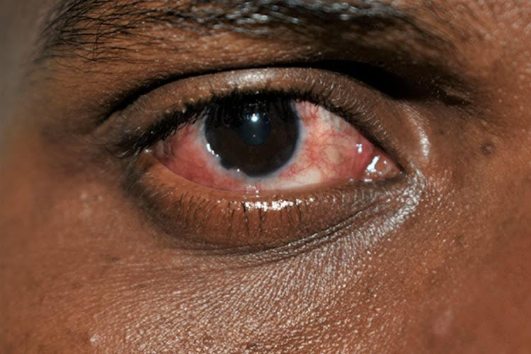 Health Ministry issues high alert over outbreak of Red Eye disease